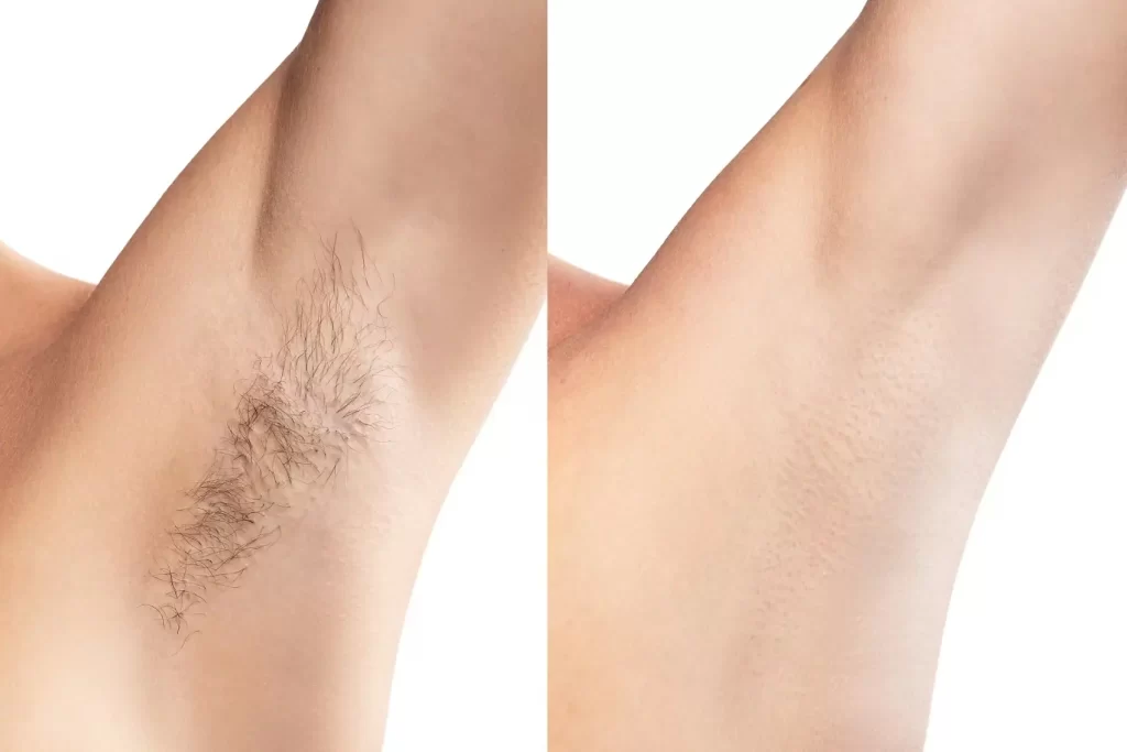 il s'agit d'une photo avant et après d'épilation au laser indolore pour un traitement d'épilation permanente, révélant que l'épilation au laser a obtenu un résultat d'épilation permanente des aisselles avant et après