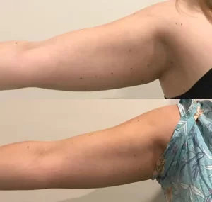 腕の脂肪減少に有効な超音波キャビテーションマシンの使用効果比較を公開した電話です