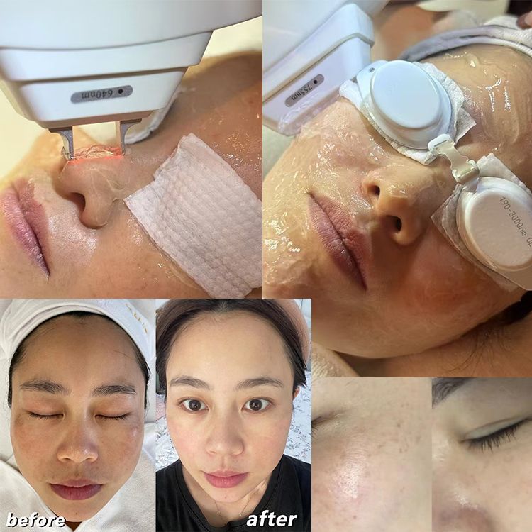Depilação fotofacial com luz celular DPL
